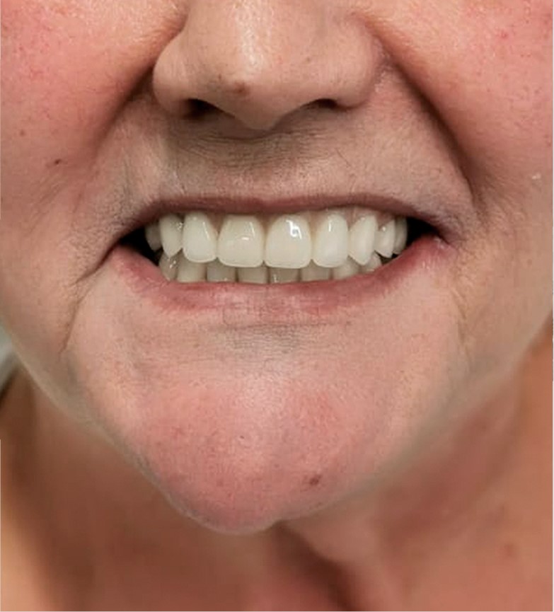 implantes dentales en algeciras