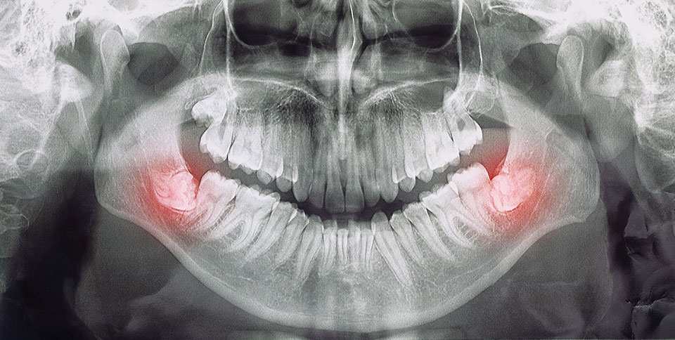 cirugia-oral-maxilofacial-muelas-juicio.jpg