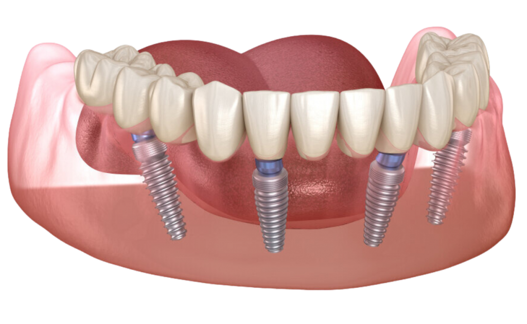 implantes-dentales-en-un-dia