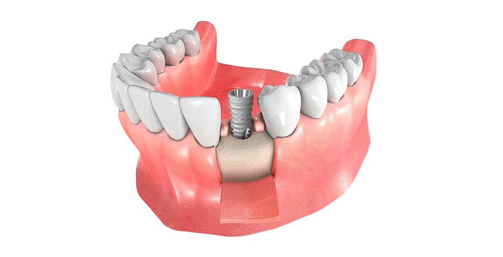implantes-dentales-granada