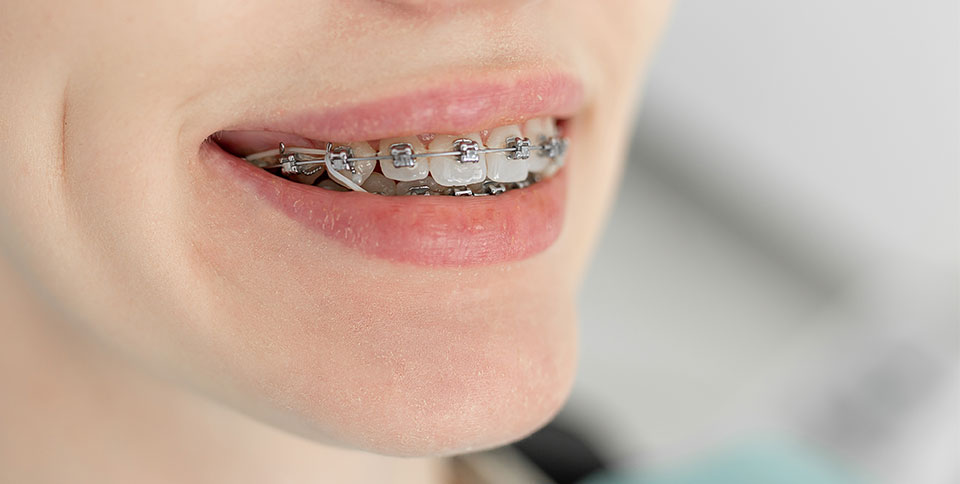 ortodoncia-brackets.jpg