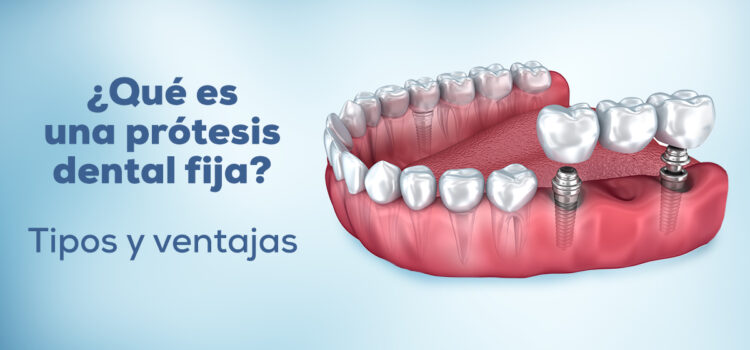 protesis-dental-fija