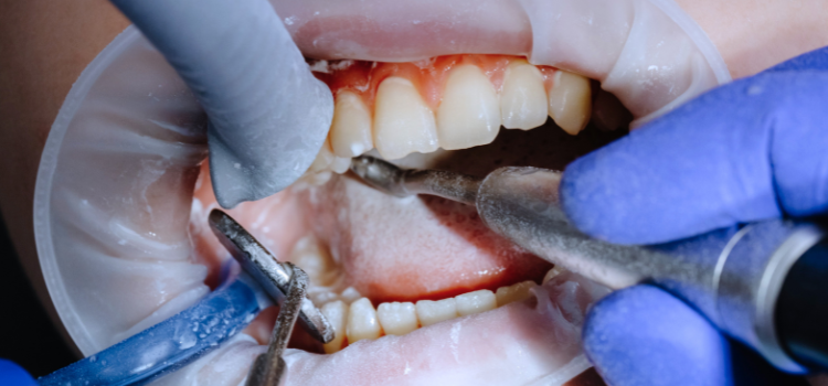 sarro en los dientes de abajo